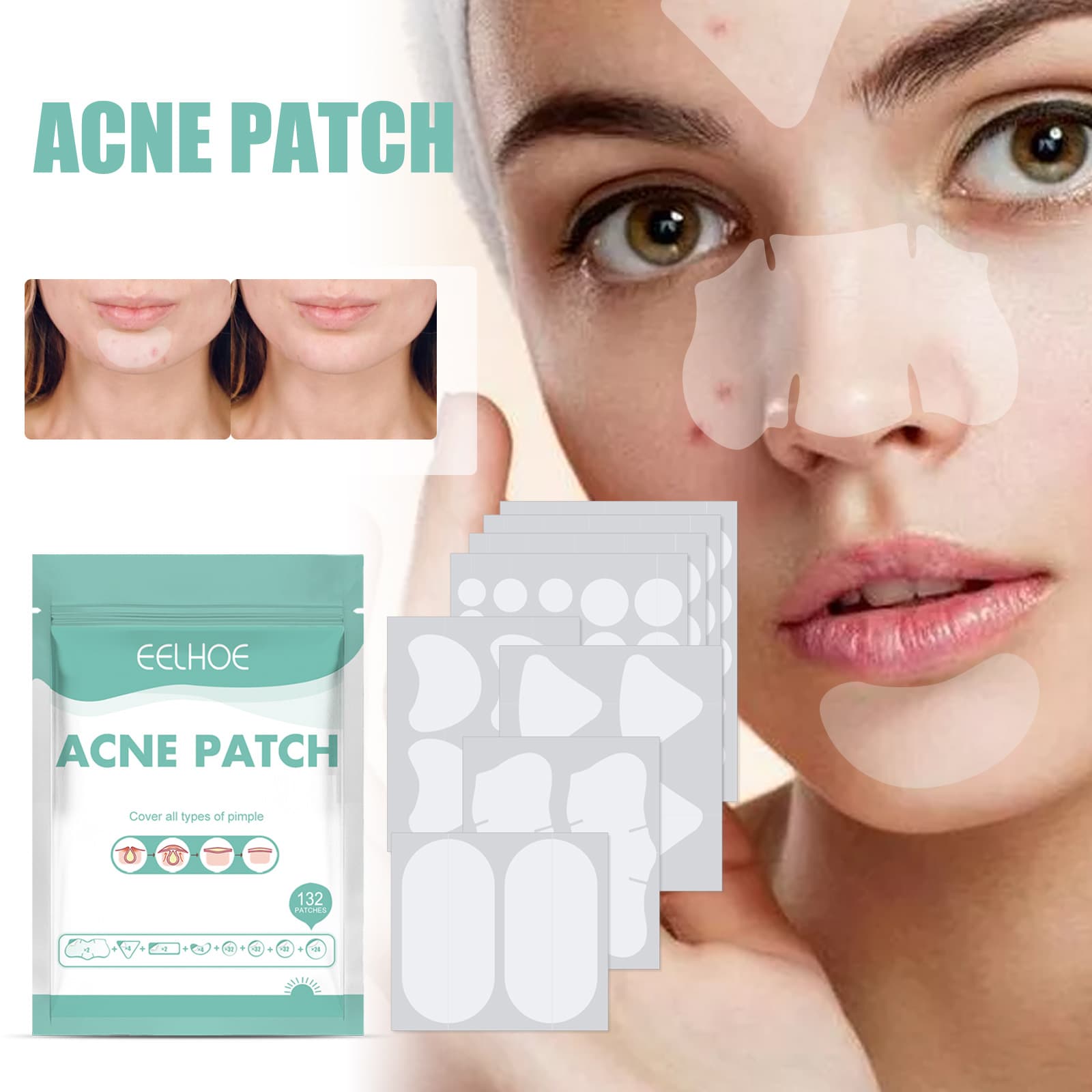 Parches de Tratamiento Anti-Acné EELHOE